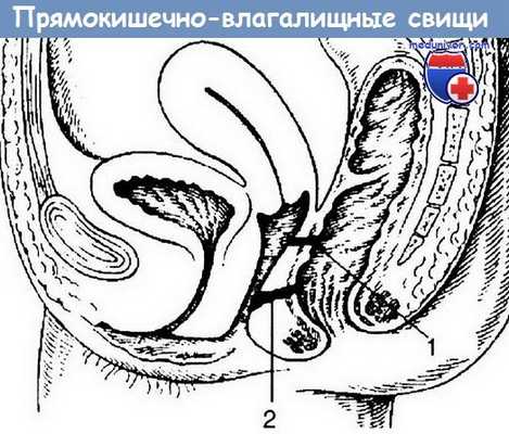 Прямокишечно-влагалищные свищи