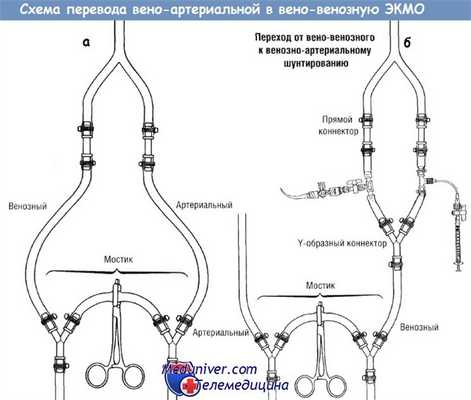 Схема перевода ЭКМО