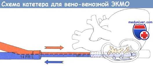 Схема катетера для вено-венозной ЭКМО