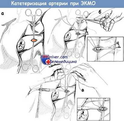Катетеризация артерии для венозно-артериальной ЭКМО