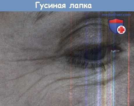 Гусиная лапка