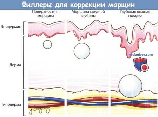 Филлеры для коррекции морщин