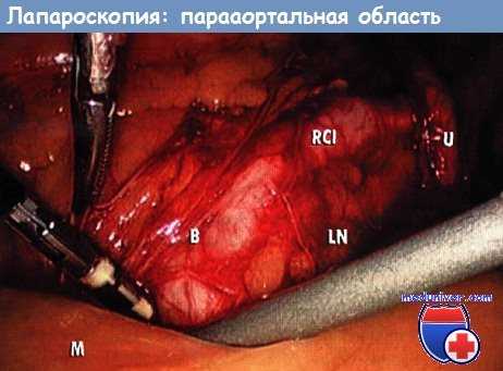 Парааортальная область - лапароскопия