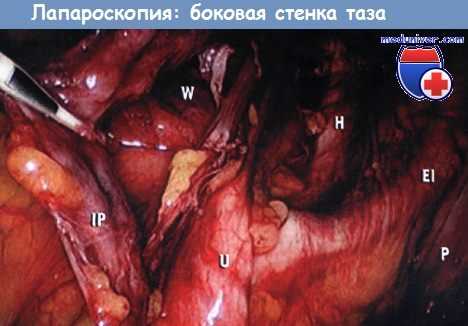 Боковая стенка таза - лапароскопия