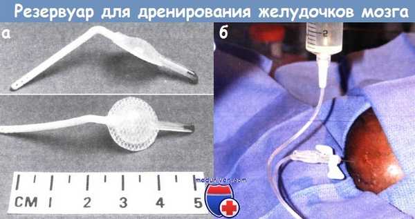 Резервуар для дренирования желудочков мозга