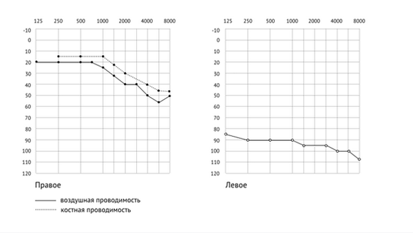 как расшифровать аудиограмму — сенсоневральная тугоухость