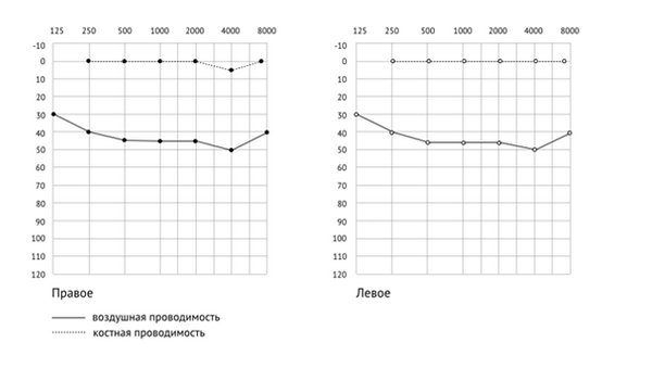 как расшифровать аудиограмму — кондуктивная тугоухость