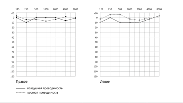 как расшифровать аудиограмму — слух в норме