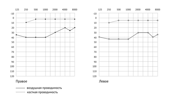 как расшифровать аудиограмму — кондуктивная тугоухость
