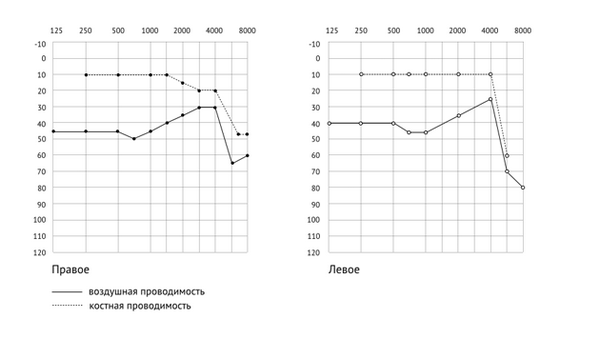 как расшифровать аудиограмму — смешанная тугоухость
