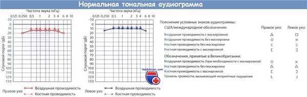 Тональная аудиограмма в норме и ее условные знаки