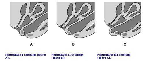 Классификация ректоцеле по степени тяжести