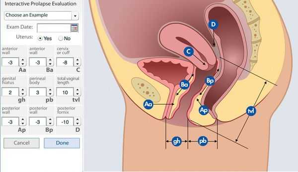 POP-Q - cистема количественного определения пролапса тазовых органов