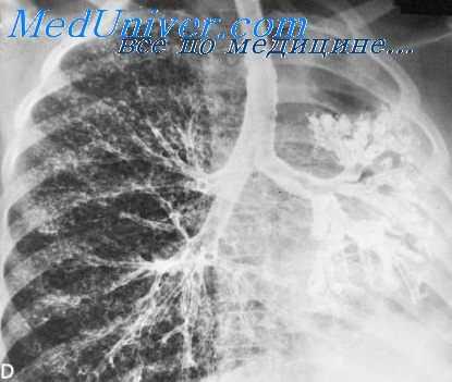 сегментарное заполнение бронхов