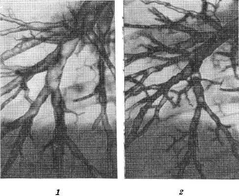 Рис. 4. Функциональная бронхография (норма): 1 — на высоте вдоха, бронхи расширены и удлинены; 2— на высоте форсированного выдоха — сужены и укорочены.