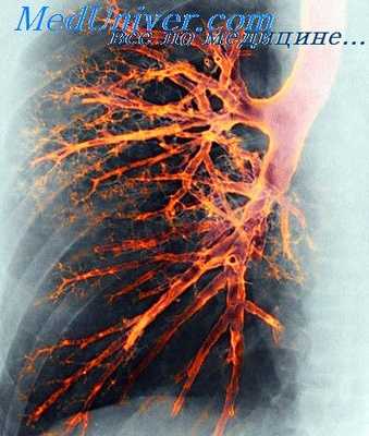 бронхография