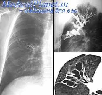 катетер для бронхографии