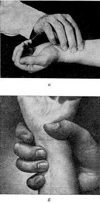 Рис. 1. Пальпация пульса на лучевой артерии: а — II, III и IV пальцами; б — III и IV пальцами с фиксацией предплечья I и II пальцами.