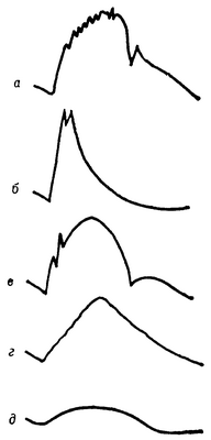 Рис. 2. Сфигмограммы при разных формах патологии: а — сфигмограмма сонной артерии при стенозе устья аорты (кривая имеет вид петушиного гребня); б — сфигмограмма сонной артерии при недостаточности клапана аорты (амплитуда кривой увеличена, инцизура отсутствует); в — сфигмограмма бедренной артерии при недостаточности клапана аорты (появление высокочастотных колебаний на анакроте); г — сфигмограмма бедренной артерии при коарктации аорты (кривая имеет треугольную форму — так называемый треугольный пульс); д — объемная сфигмограмма стопы при облитерирующем эндартериите (кривая имеет куполообразную форму, дикротическая волна отсутствует — так называемый коллатеральный пульс).