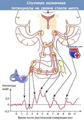 Слуховые вызванные потенциалы на уровне ствола мозга
