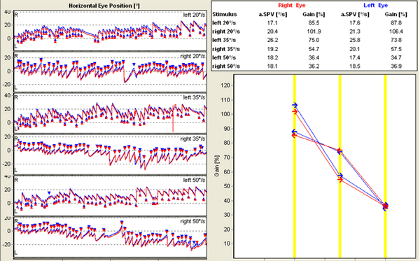 Нормальный результат Оптокинетического Теста