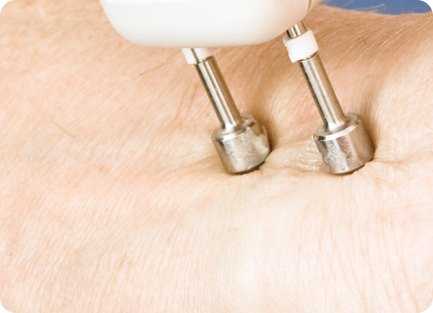 ЭНМГ (электронейромиография)