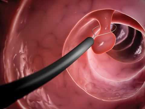 Электроэксцизия полипа