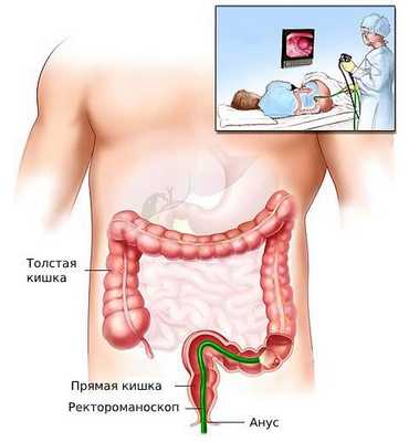 Ректороманоскопия