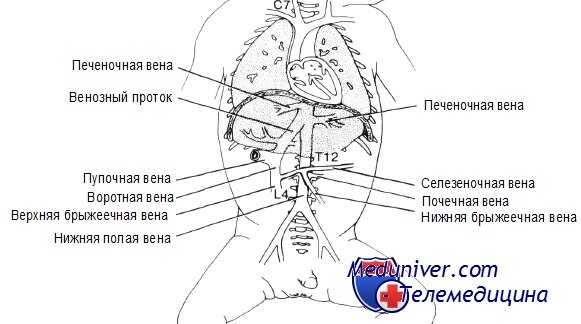 катетеризация пупочной вены