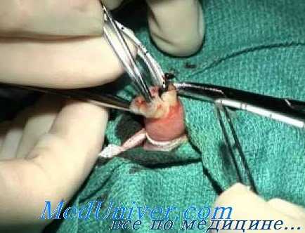 катетеризация пупочной артерии