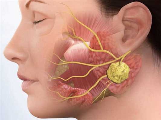 Удаление подчелюстной слюнной железы