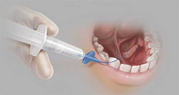 Удаление камня слюнной железы