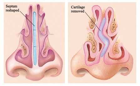 Строение носовой перегородки