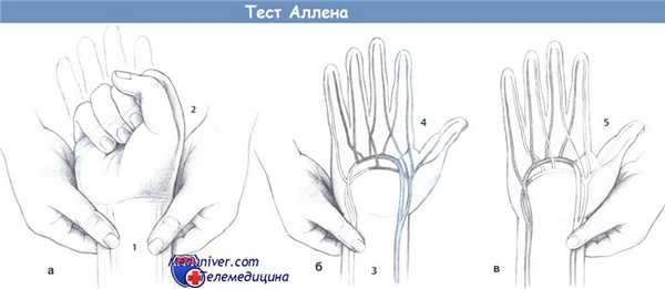 Тест Аллена