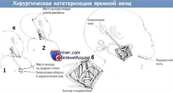 Хирургическая катетеризация яремной вены у новорожденного