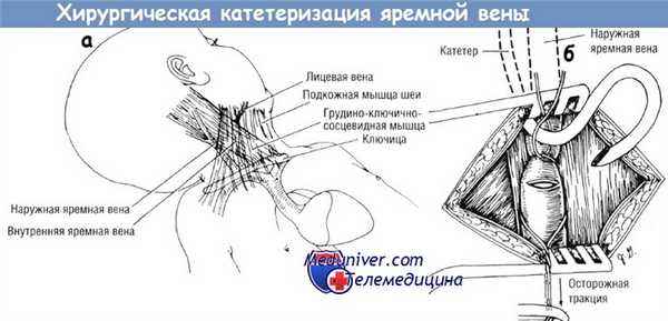 Хирургическая катетеризация яремной вены у новорожденного