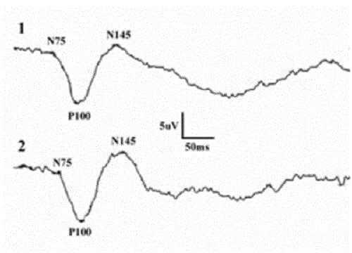 Зрительные вызванные потенциалы при патологии перекреста