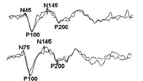 Нормальные зрительные вызванные потенциалы