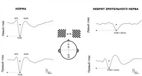 Вариант нормы и патологии на ЗВП