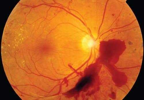 Патология сетчатки при осмотре глазного дна