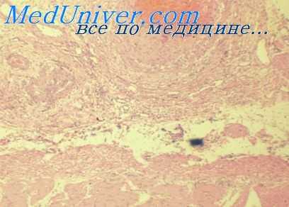 сдавление шеи петлей