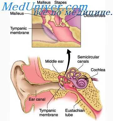 отосклероза и отоспонгиоз