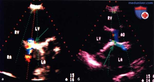ЭхоКГ оценка протезированного клапана сердца
