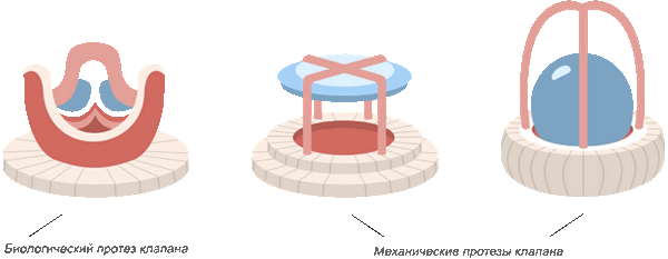 Два основных типа искусственных клапанов