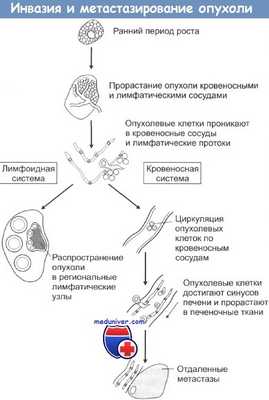 Инвазия и метастазирование опухоли