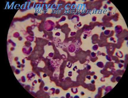 висцеральный лейшманиоз