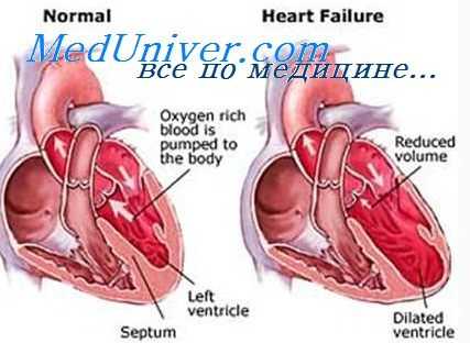 сердечная недостаточность