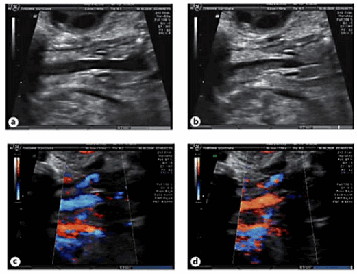 Атрезия хоан