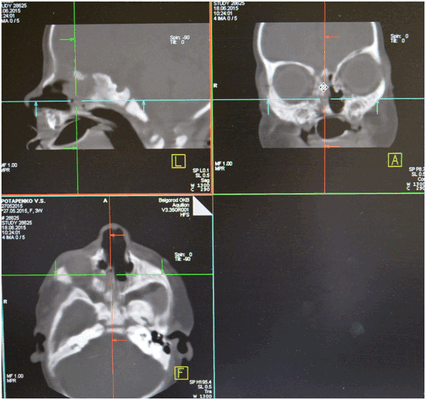 атрезия хоан