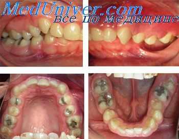 нарушения прикуса